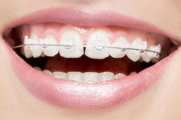 Things To Know About Clear Braces