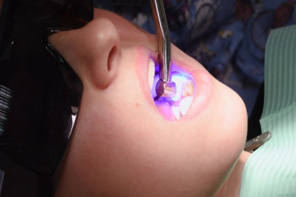 How Does A Dental Filling Work?