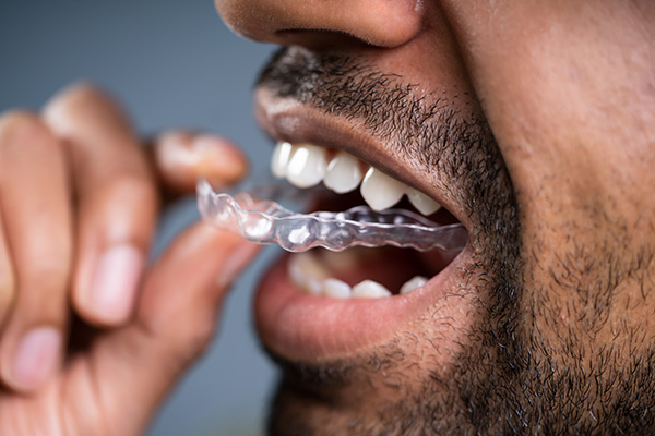 A Cosmetic Dentist Explains Benefits of Clear Aligners from Casas Adobes Dentistry in Tucson, AZ