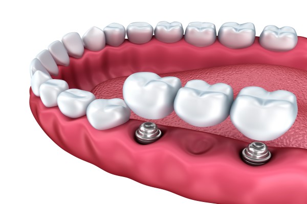 What Is An Implant Supported Bridge?
