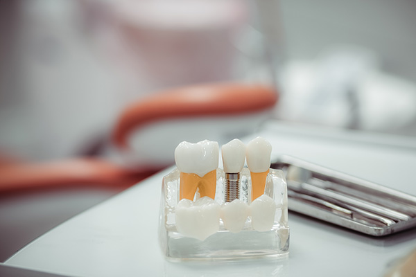 Dental Implants Surgery FAQs