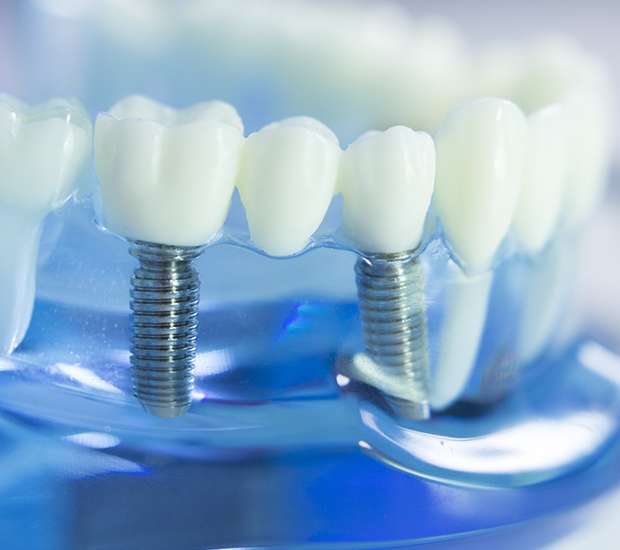 Tucson Dental Implants