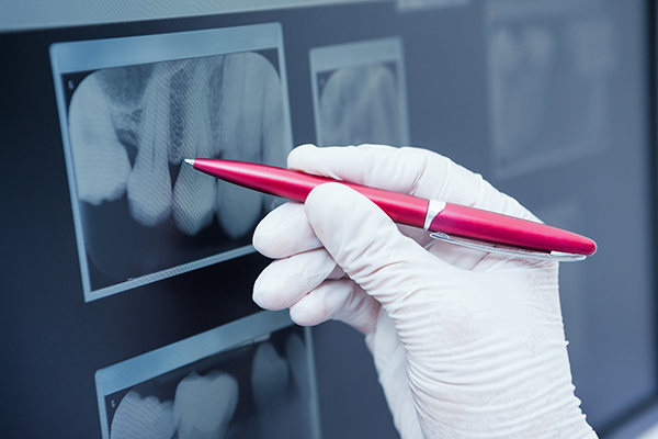 Getting Digital X Rays From A General Dentist
