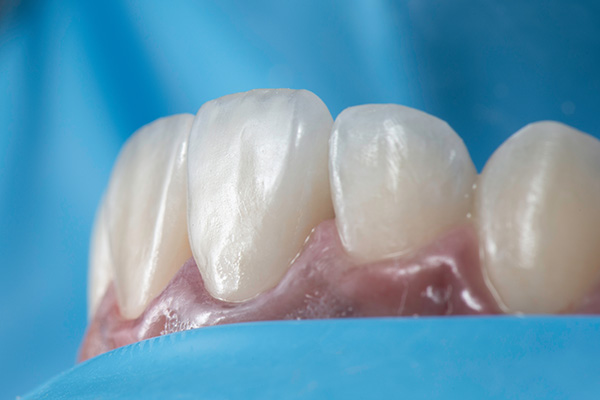 When a General Dentist May Suggest Dental Bonding from Casas Adobes Dentistry in Tucson, AZ