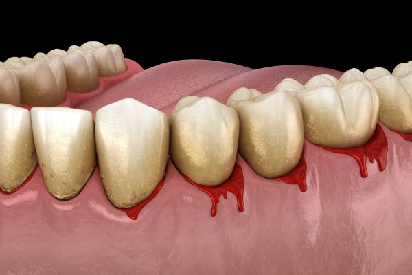 What Bleeding Gums May Indicate