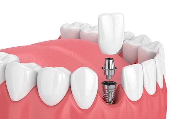 How Painful is Dental Implant Surgery from Casas Adobes Dentistry in Tucson, AZ