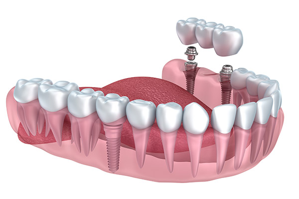 Implant Dentistry Supported Bridge from Casas Adobes Dentistry in Tucson, AZ
