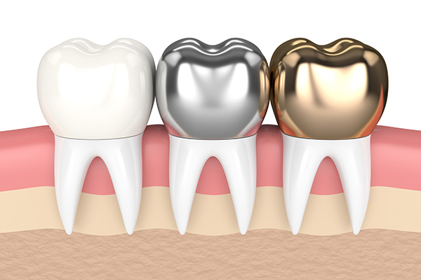 Metal Crowns vs. Porcelain Dental Crowns from Casas Adobes Dentistry in Tucson, AZ