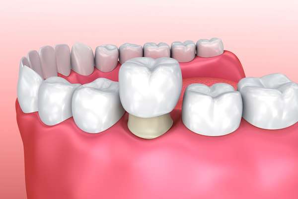 Permanent Dental Crowns vs. Temporary: Is There a Difference from Casas Adobes Dentistry in Tucson, AZ