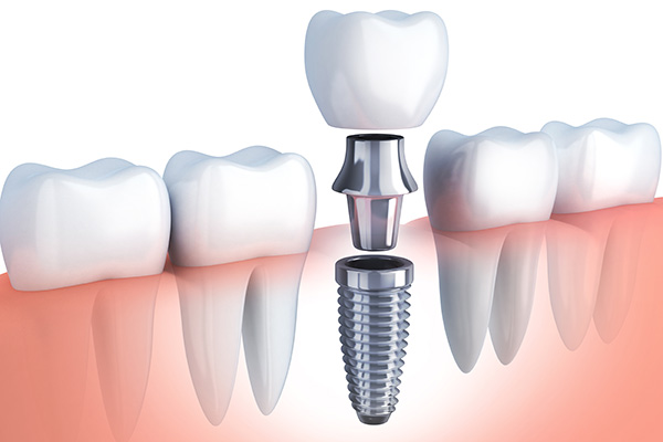 Questions to Ask Your Implant Dentist from Casas Adobes Dentistry in Tucson, AZ