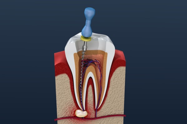 Root Canal Questions: What Is Tooth Pulp?